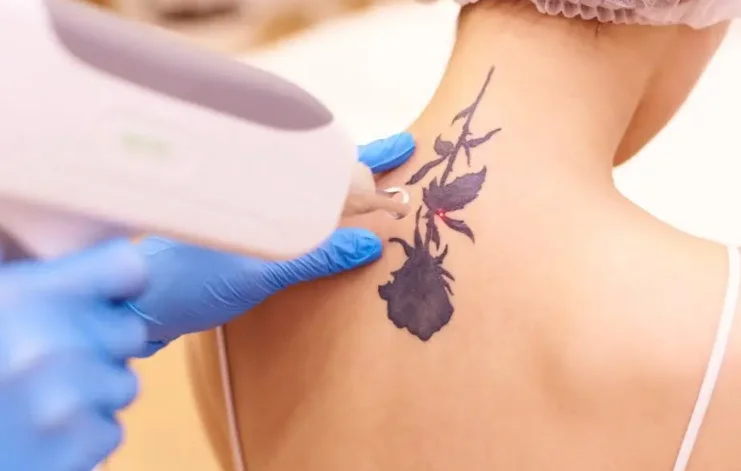 Tattoo removal scar not a ground for disqualification in CAPF, Assam Rifles: Rajasthan High Court