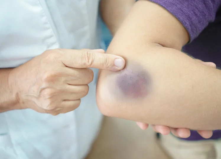 To Attract Applicability Of Section 324 IPC, Voluntary Hurt Must Be Caused By 'Dangerous' Instrument Which Can Cause Death: Jharkhand High Court